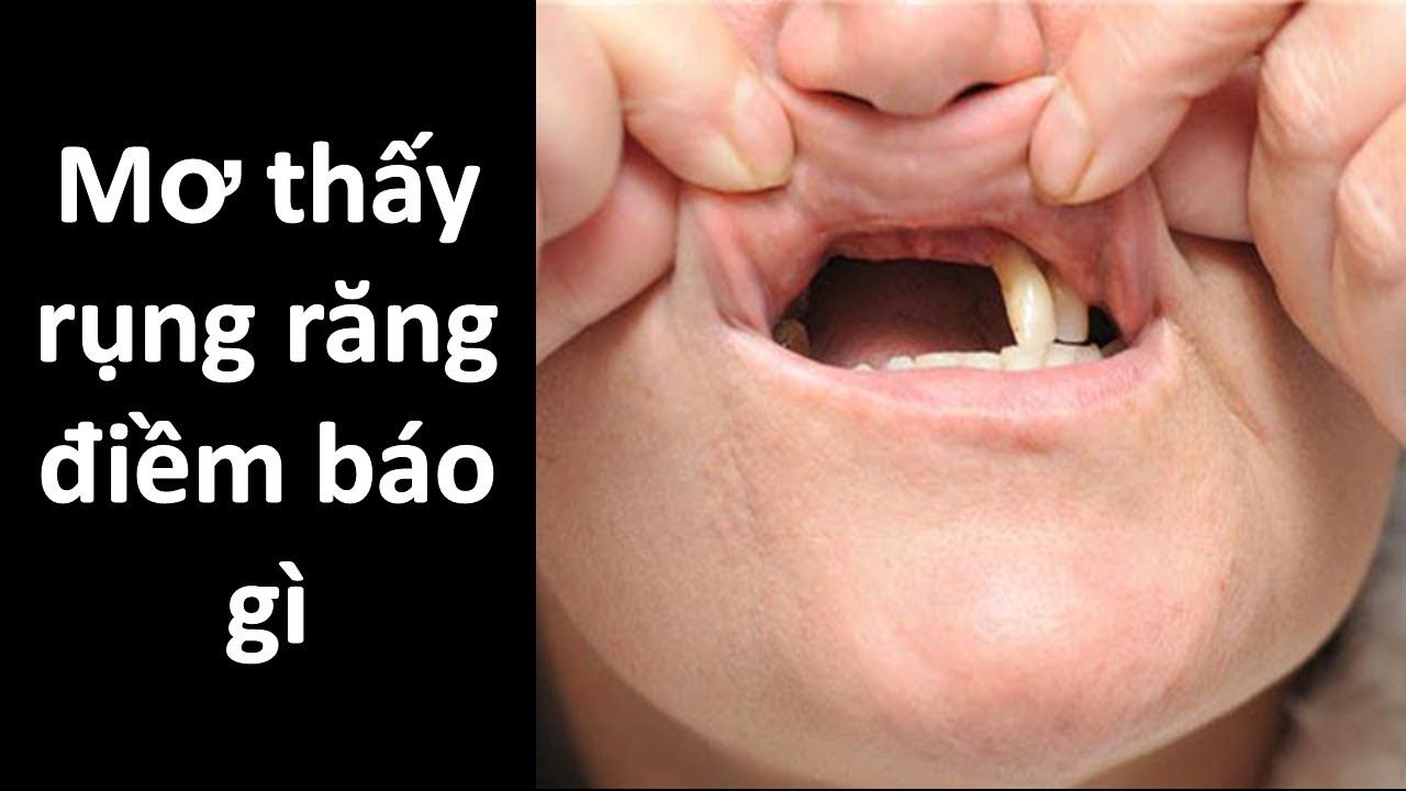 Mơ Thấy Rụng Răng: Giải Mã 15+ Điềm Báo & Hóa Giải Theo Phong Thủy