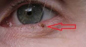 Nốt Ruồi Ở Mí Mắt Dưới: Giải Mã Vận Mệnh & 7 Điều Cần Biết!